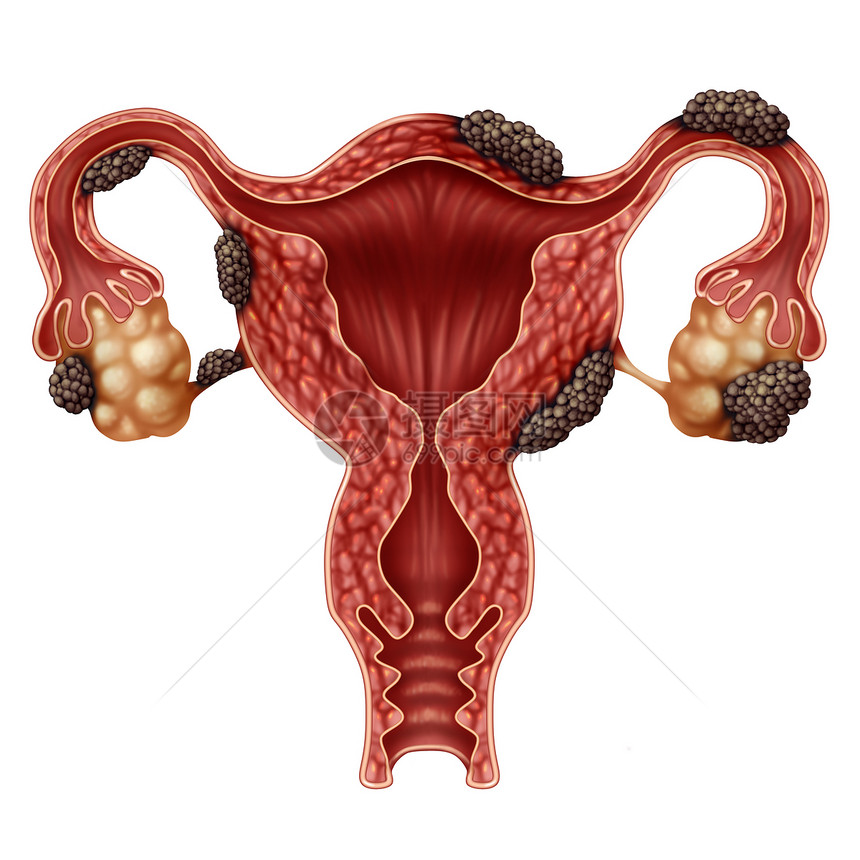 内分泌硬化疾病解剖概念作为女不孕症作为子宫卵巢和输管带有组织生长的3个插图元素图片