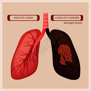 肺病医学吸烟者高清图片