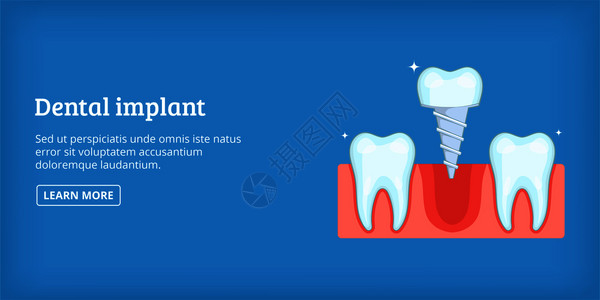 植萃牙科植横向概念科植横向图画网上向矢量牙科植横卡通风格插画