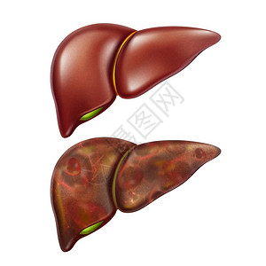 肝健康研究和疾病肝硬化癌症胃病肝炎和症高清图片