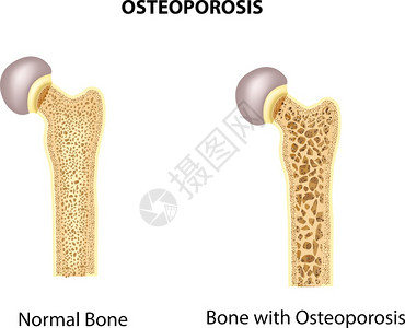 股骨正常骨骼和质疏松插画