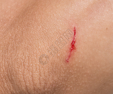 伤口有很多划痕人体皮肤外伤背景