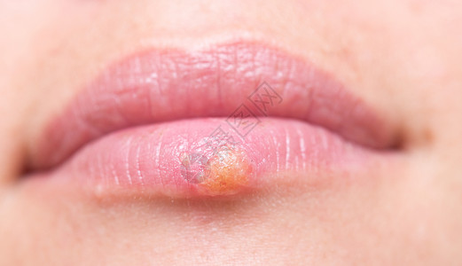 损伤皮肤紧拍到嘴唇上的疹背景