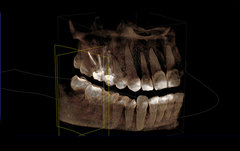 牙齿建模图3d可视化计算机缩写图的直映背景