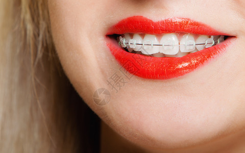 带着牙套的快乐微笑女孩脸部分牙齿直线卫生科诊所健康生活方式背景图片