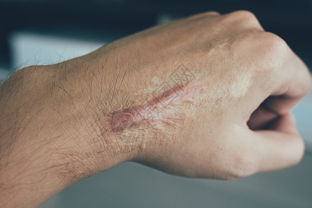 去疤痕手头上有人类皮肤的疤痕背景