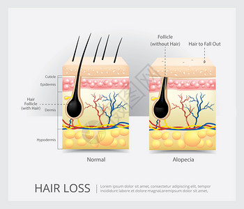 头发结构毛发损失结构矢量说明插画