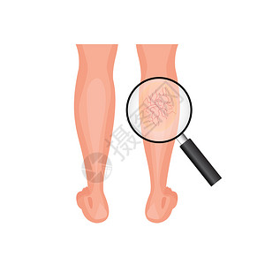 血管变动和正常腿部问题的放大概念图片