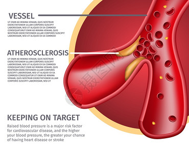定增CrossCreatyRealisticAtherroscleraticsessions解剖矢量说明医疗心脏病风险导体指定血压增插画