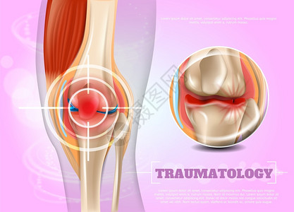 膝盖疼痛3dBannerVictor图像闭合解剖和人体膝盖结构联合InfographicsResearchProblemsandpain插画