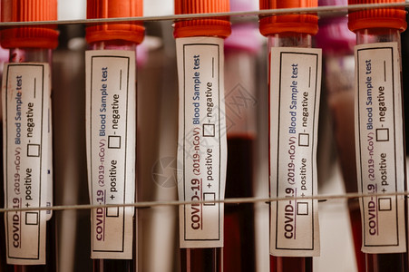 新冠19测试和化验室血样本用于诊断具有实验室背景的新科罗纳感染2019年新科罗纳疾2019年新科罗纳的血液检测背景