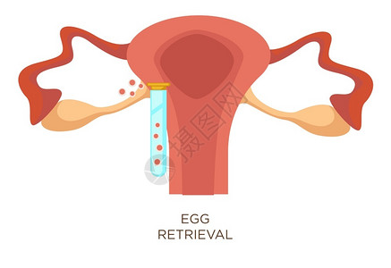 充能体外受精卵回收阶段人工受精病媒子宫和用卵雌生殖系统的试验管进行人工受精的子宫以及用卵女生殖系统进行测试的卵子女生殖系统的解剖育能插画