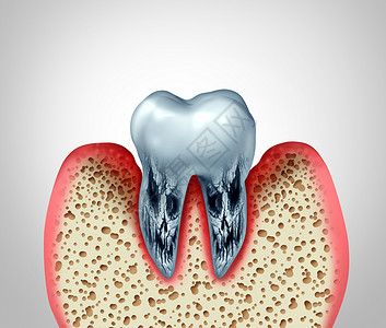 3D斑块3D说明由于细菌感染以及骨骼腐烂和口香糖炎的洞穴或牙齿口腔疾病和垂口腔卫生问题很差背景