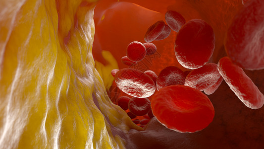 3D斑块动脉血液容器和流动细胞中的胆酯醇板3D说明动脉中的胆酯醇板背景