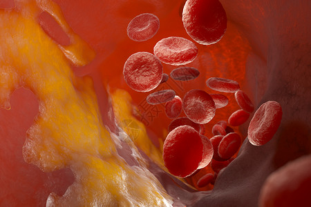 血液细胞动脉血液容器和流动细胞中的胆酯醇板3D说明动脉中的胆酯醇板背景