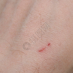 痘疤手部伤疤挫造成的小疤背景