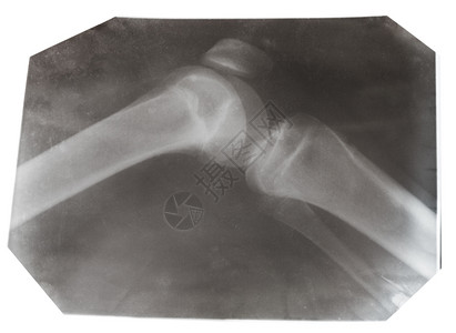 在白色背景上隔离的人类膝盖合照X光片图片