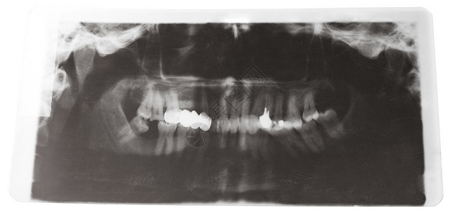 X射X光照片以白色背景孤立的牙科冠拍摄人的下巴图片
