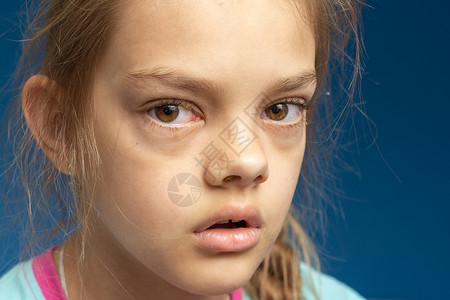 一个十岁女孩面前的结节炎图片