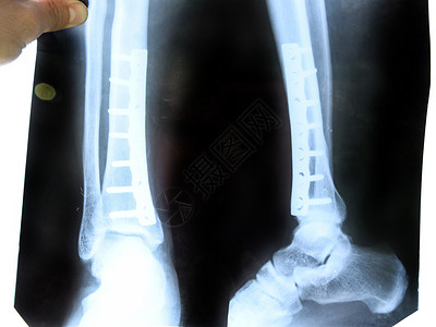腿部骨折腿部X光片一根钢板将腿部Tipia放在一起钢板将腿部Tipia放在一起背景