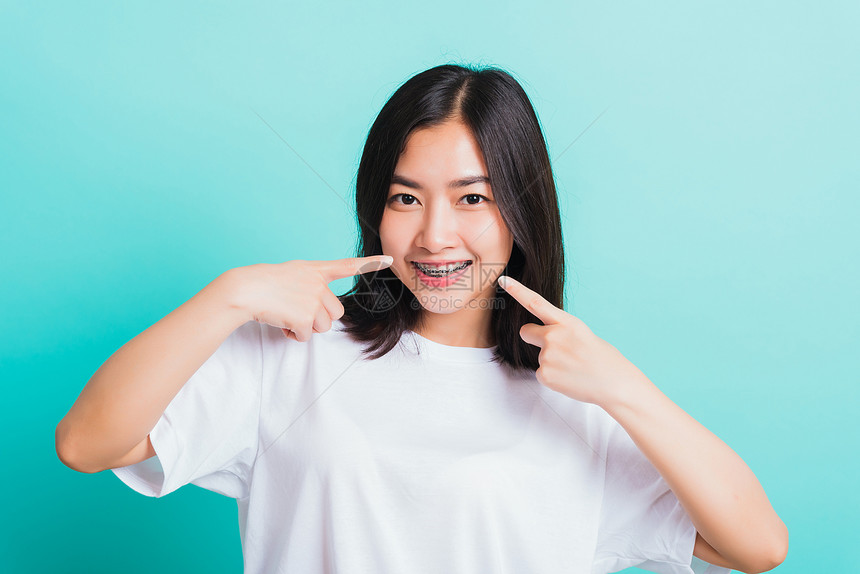 亚洲年轻美丽的女子微笑肖像有牙套齿笑尖指她的嘴摄影棚拍以蓝背景孤立医学和牙概念图片