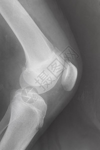 在X光图像上膝盖骨与相连接的人类膝盖侧面背景图片