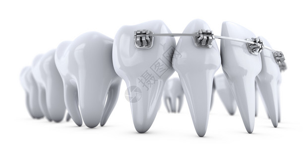 嘴支撑装在牙齿上的金属括号3d插图图片