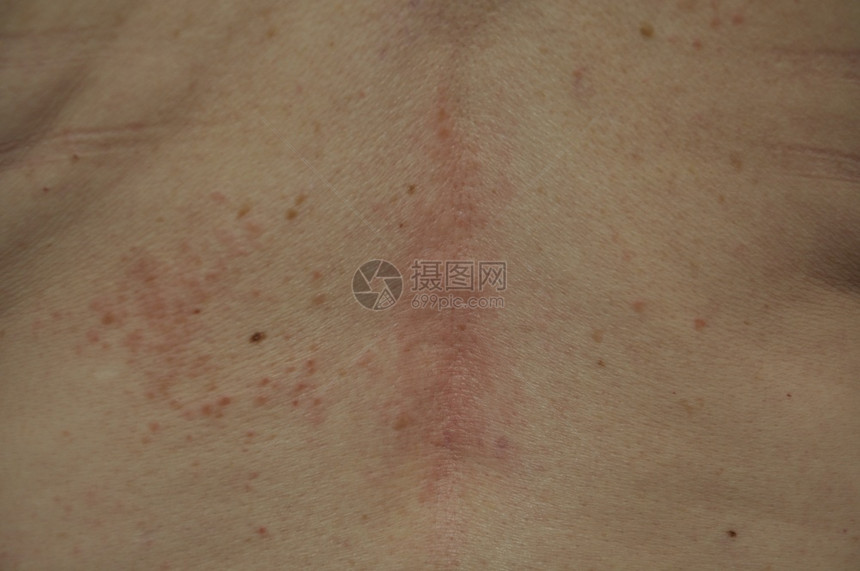 表皮背部的阴疹炎医疗图片