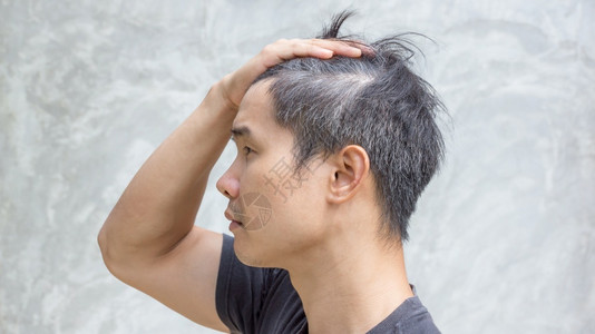头发护理秃顶忧虑年轻的亚洲人有灰色头发图片