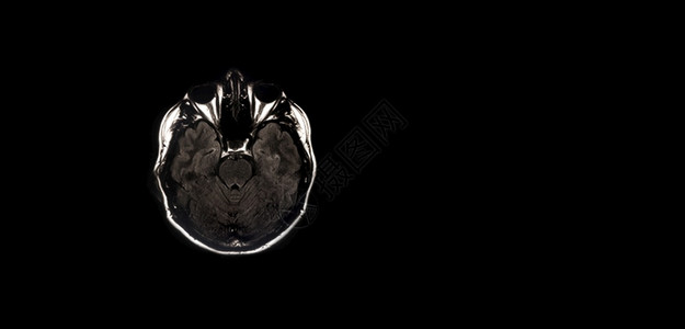 正常大脑的磁共振图像MRI全景模拟型X射线磁的考试图片