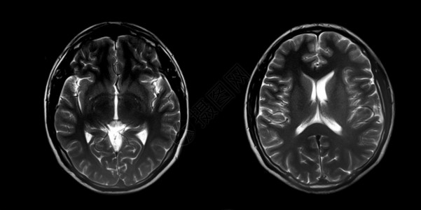 两张测试用纸黑色的谐振正常大脑磁共振图像MRI全光脑断层摄影健康设计图片