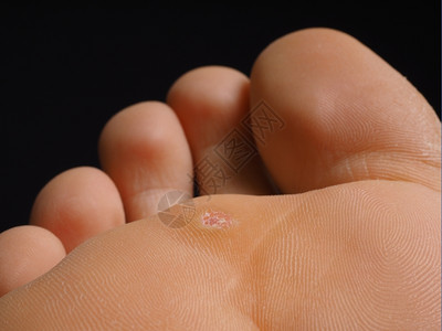 女士皮肤脚跟紧一个被感染的蚊子放在脚趾下与黑色隔绝男人图片