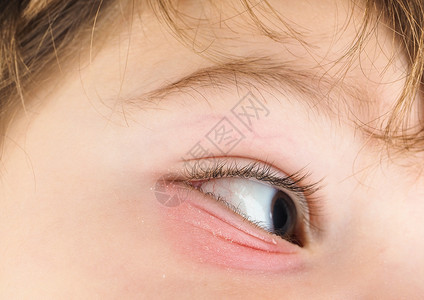 面目全非粉红眼睛对一个男孩子与棕色眼睛和黑褐头发的紧闭过敏医疗图片