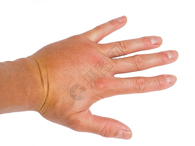 刺男在左手上显示肿胀的指关节健康丑陋高清图片
