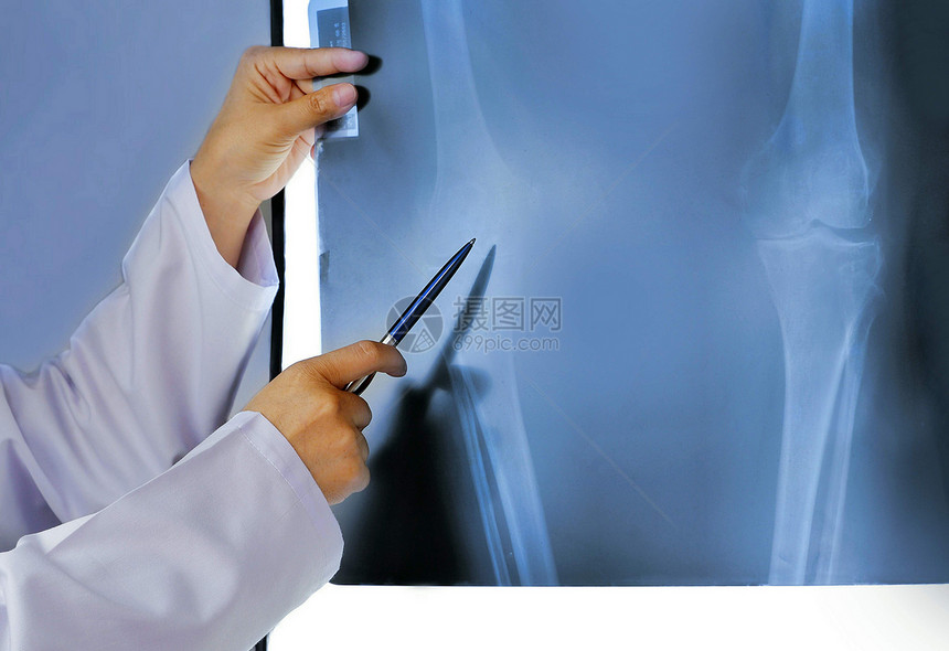 泰国指点诊所使用笔膝的女医生用手在院职业和疗护理概念下的放射矫形科X光片中用笔指膝部与X光片结合图片