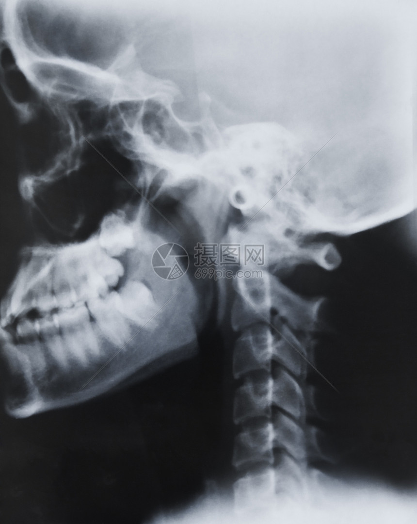 黑白X光胶片上的人类头部考试科学的电影图片
