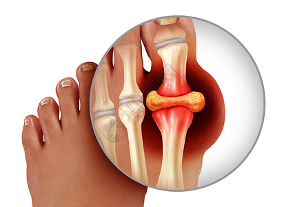 达古冰川一种手术以3D插图样式作为治疗和诊断白种背景孤立的慢疼痛高血糖贫象征指脚趾紧贴人的作为治疗和诊断白种背景下的慢疼痛标志类风湿设计图片