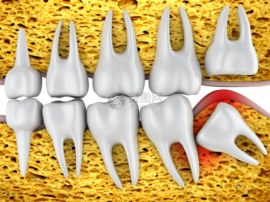 医疗的牙齿和不正确定位的智牙3D转化工具牙疼插图图片