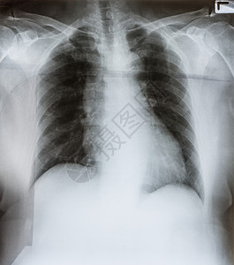 慢阻塞肺病女健康XRay人类男胸罩图像图片