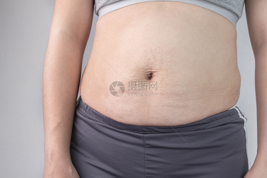 饮食女士为了妇腹部皮肤近前视在分娩后有伸展痕迹和松皮对肤身体形状的保健概念图片