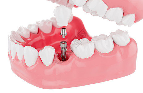 鼻假体胶白底植树牙齿保健选择焦点3D立体切除器植入物使固定设计图片