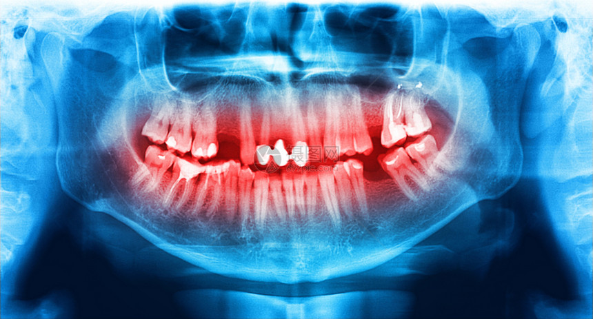 解剖学光谱射电仪是上下巴的扫描牙科X光片该照显示一名307岁的年轻人重建齿图片