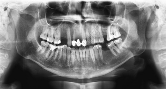 医疗的颚光谱电仪是上下巴的扫描牙科X光片该照显示一名307岁的年轻人图片