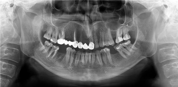 首焦图颅骨泛光射电图是全景扫描的牙科X线上下两端这是一架焦平面断层摄影仪显示一个40岁的男子最大和可变体民主共国下颌骨背景