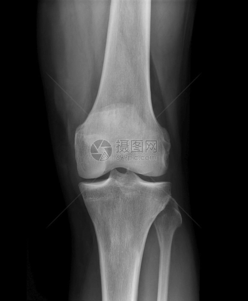 骨关节x光片图片