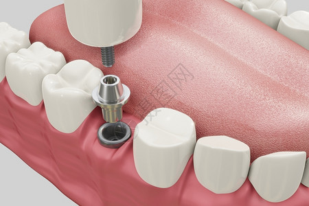 正畸3D假牙种植设计图片