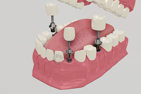 正畸3D假牙种植设计图片