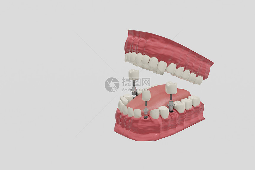 3D假牙种植图片