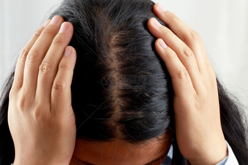 女人的头发和皮有问题她对洗发水和理机过敏反应会露出来拥有损失分泌图片