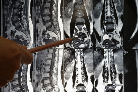 腿背部人类脊柱X光薄膜上线的人体子宫颈磁共振成像图片